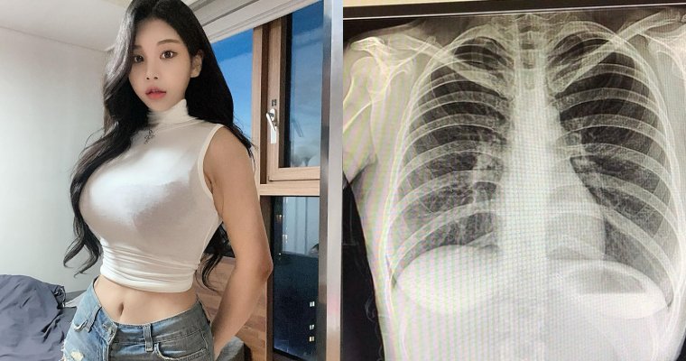 南韓「百萬網紅」不滿被質疑整形…曬 X 光照自證清白：我沒有動過手術